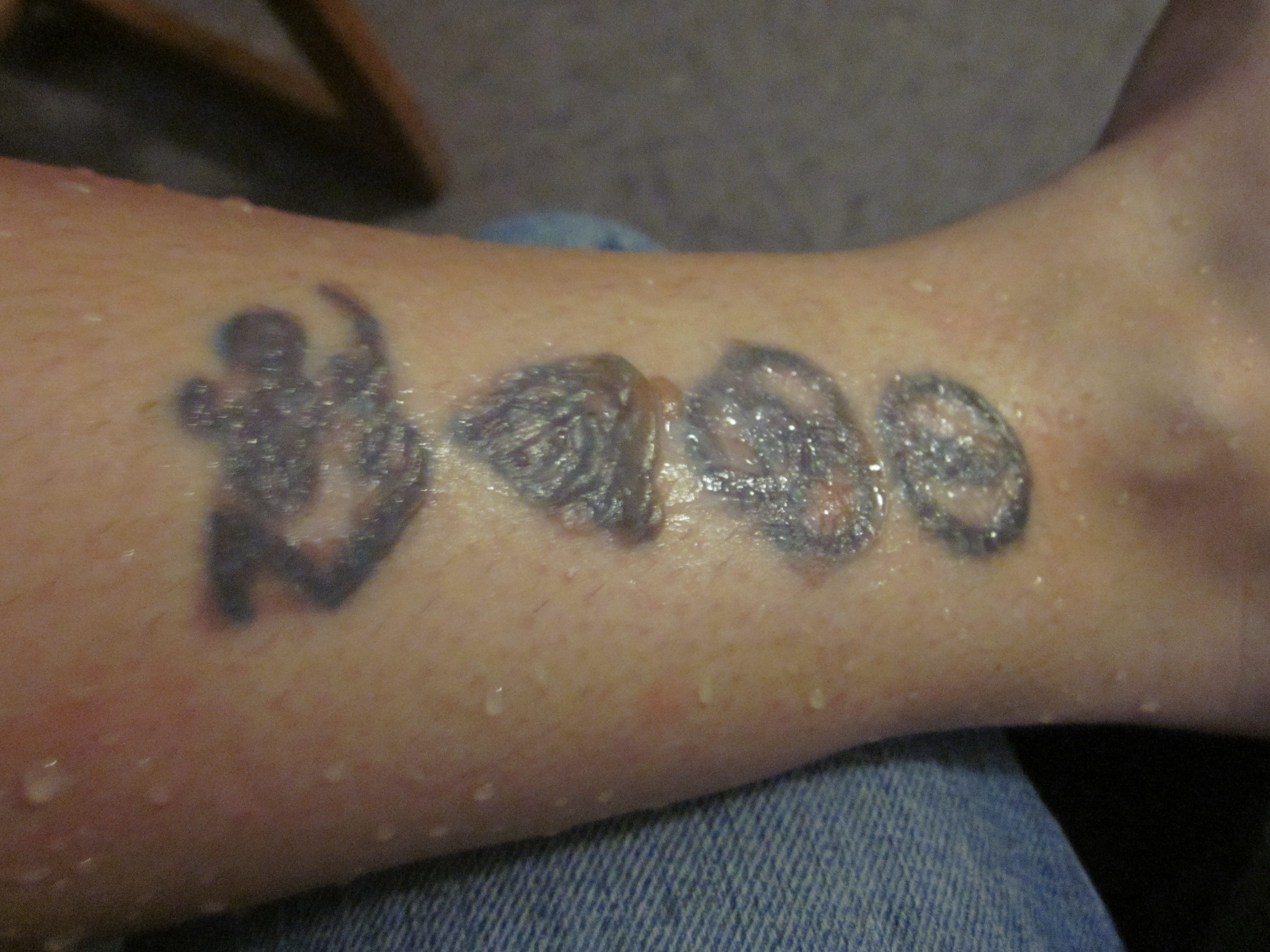 Laser Tattoo Removal Aftercare, Treatment and Instructions | Blog